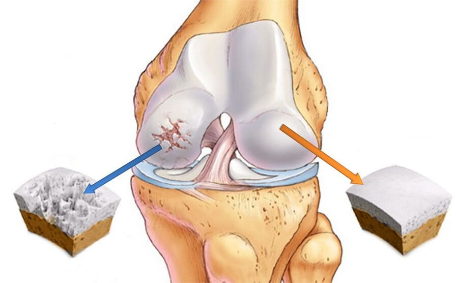 Arthrose de l'articulation du genou et cartilage sain