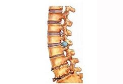 Stades de développement de l'ostéochondose cervicale