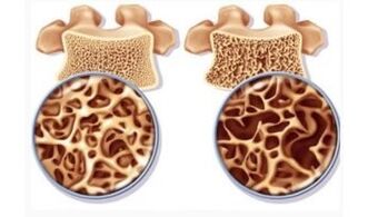 Danger d'aspiration cervicale pour les femmes