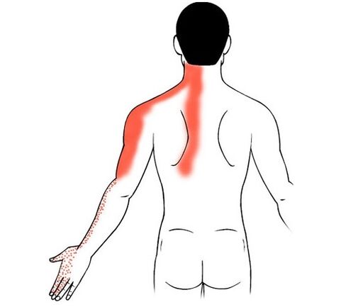 ostéochondrose cervicale comme cause de douleur dans les articulations des doigts