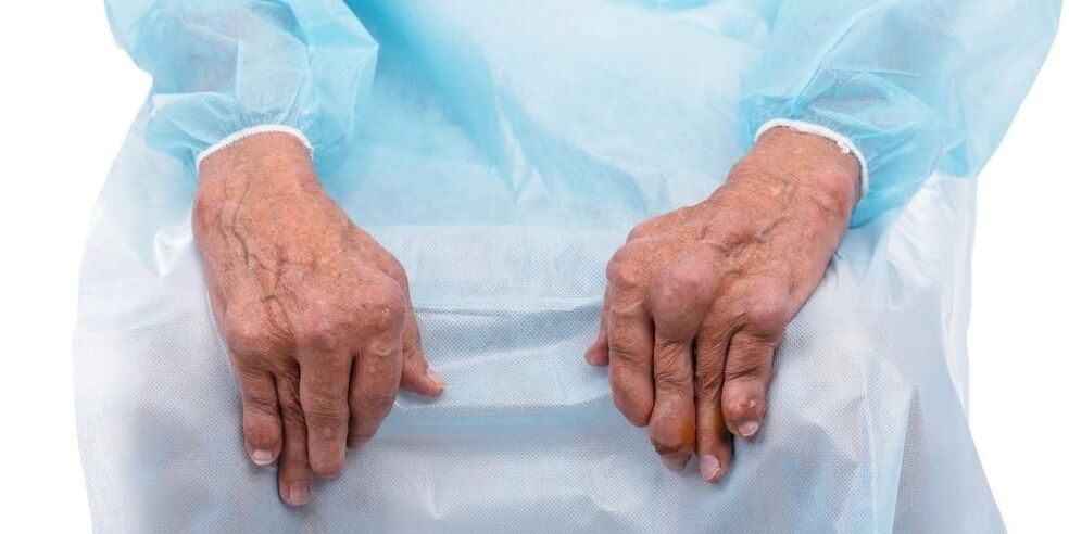 L'arthrite infectieuse est une maladie caractérisée par des douleurs constantes et des modifications des articulations des doigts.