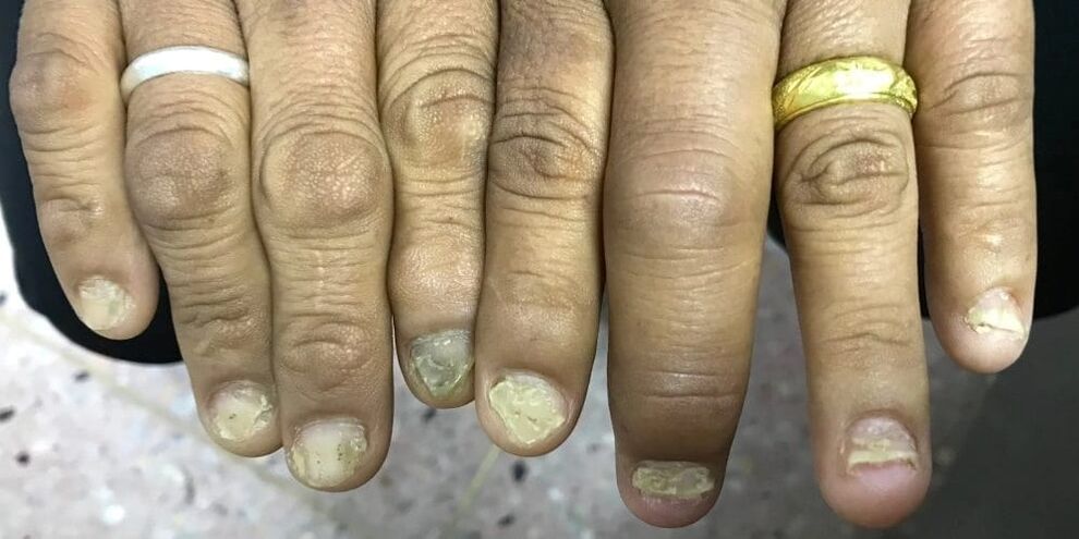 Un gonflement des doigts et une déformation de la plaque à ongles peuvent indiquer le développement d'un rhumatisme psoriasique.