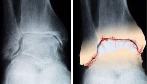 articulation saine et arthrosique